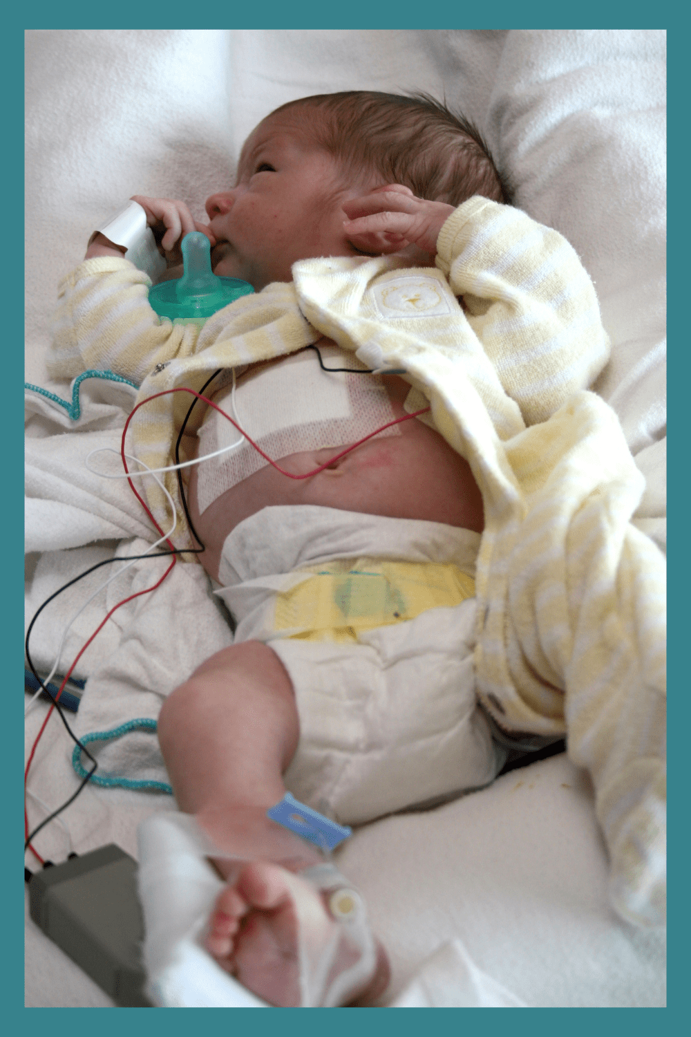 A newborn baby in intensive care
