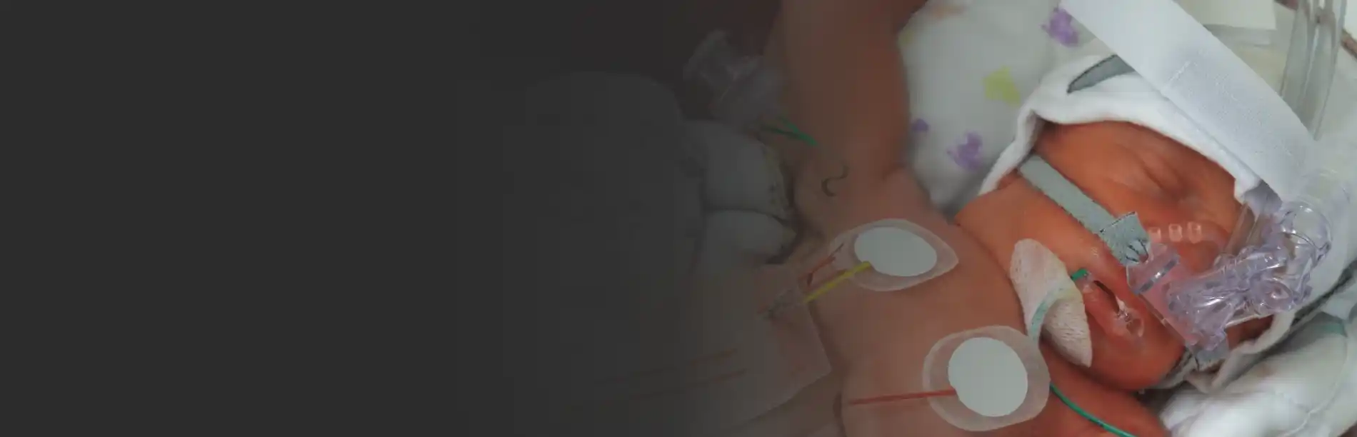 A premature baby in the NICU